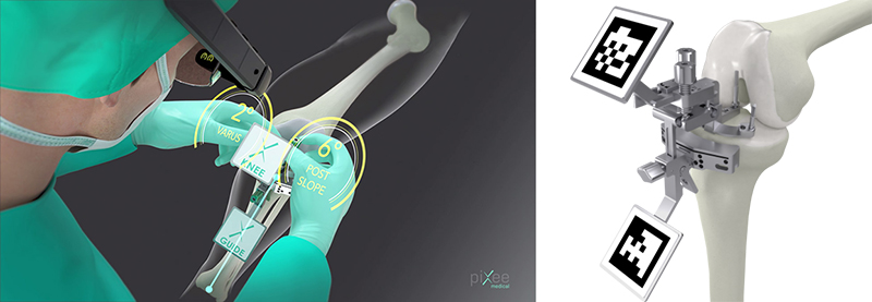  Ολική αρθροπλαστική γόνατος με σύστημα πλοήγησης PIXEE ΚΝΕΕ+