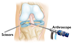 Αρθροσκοπική Χειρουργική