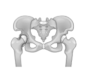 Ρομποτική Αρθροπλαστική Ισχίου| Arthroscopy Center