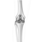 Ρομποτική Ολική Αρθροπλαστική Γόνατος| Arthroscopy Center